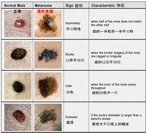 右手食指突然長痣|痣也可能会癌变！长在 3 个地方要注意